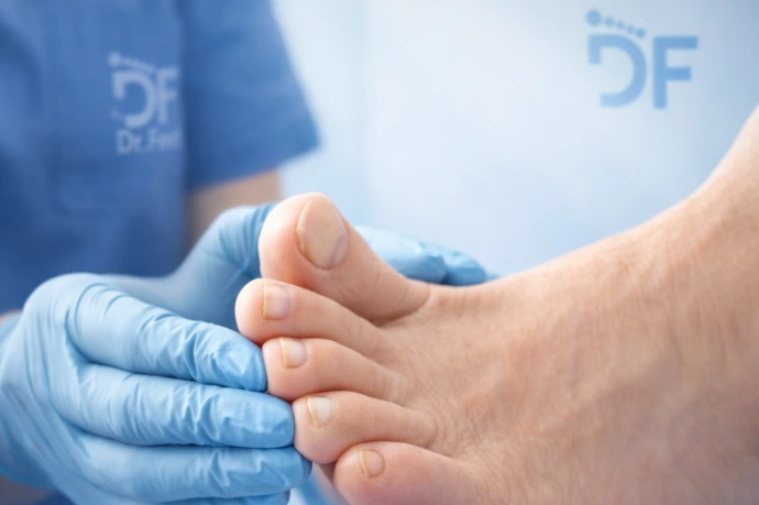 Cuidado profesional para uñas con hongos Cuidado profesional orientado a mejorar la apariencia y condición de uñas afectadas por onicomicosis, con orientación para seguimiento adecuado.